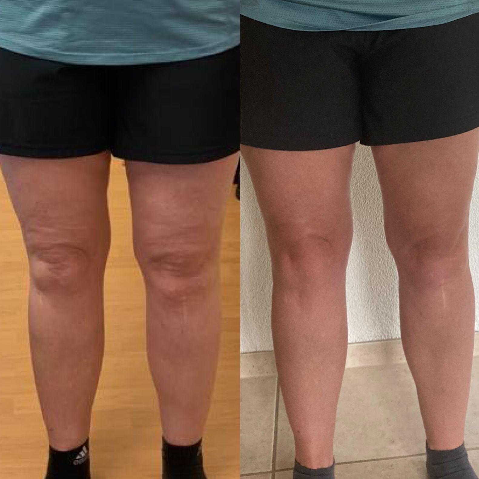 Kombi TeoPulse + TeoFlow Ergebnis Oberschenkel — 10er-Abo