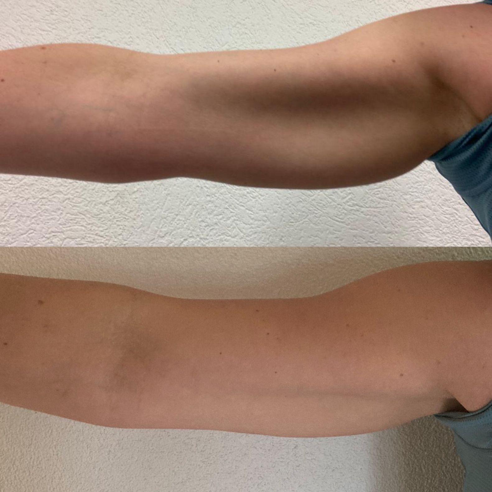 Kombi TeoPulse + TeoFlow Ergebnis Arme — 10er-Abo