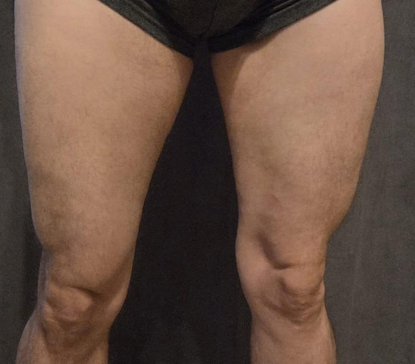 TeoPulse T13 Ergebnis Oberschenkel — 5x 10er-Abo